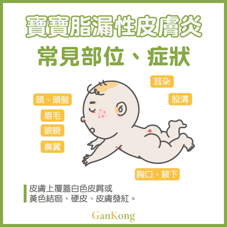 寶寶漏之性皮膚炎常見部位、症狀