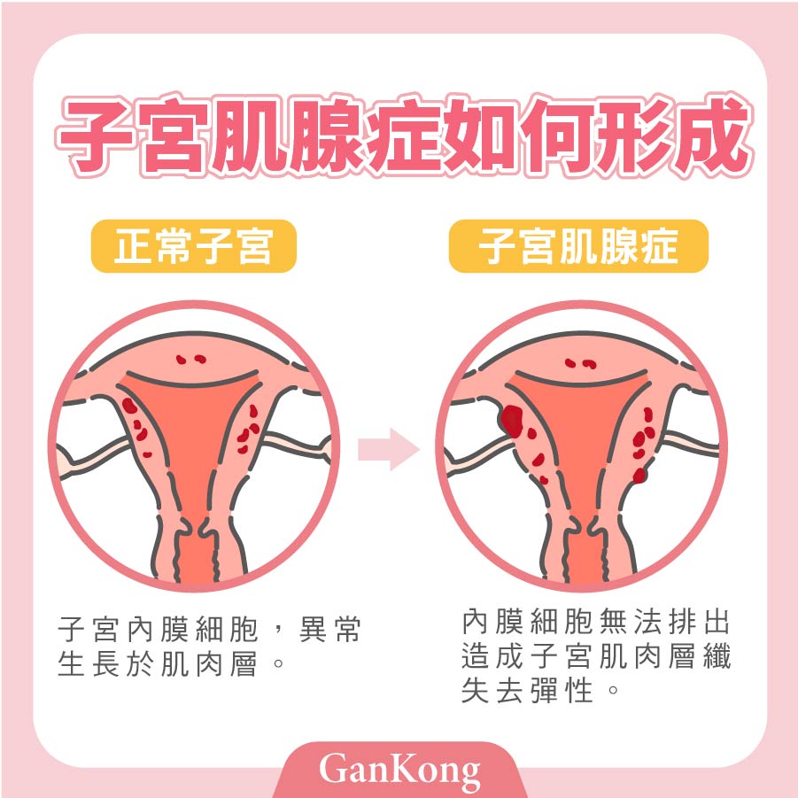子宮內膜異位、巧克力囊腫、肌腺症是因為子宮內膜細胞轉移到子宮肌肉層或是卵巢造成的症狀，可能造成不孕、嚴重經痛